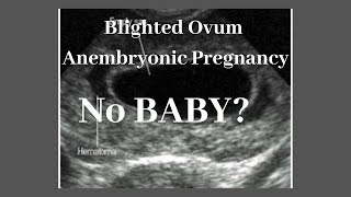 ANO ANG BLIGHTED OVUM or ANEMBRYONIC PREGNANCY WAG MAWALAN NG PAGASA MAY CHANCE PA MABUO ANG BABY [upl. by Corson]