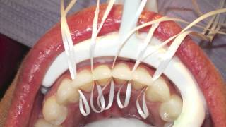 Retanium Splint Placement Orthodontics [upl. by Novyert]