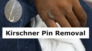 Kirschner Wire Removal Procedure [upl. by Ylyl]