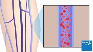 How superficial thrombophlebitis develops [upl. by Yttam82]