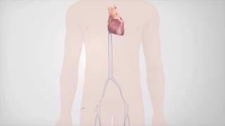 Radiofrequency Catheter Ablation [upl. by Laniger]