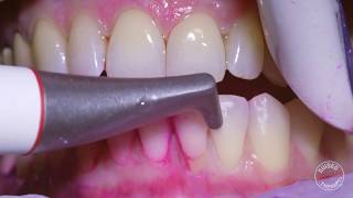 How teeth should be cleaned at the Dentist  Hygienist [upl. by Rebhun]