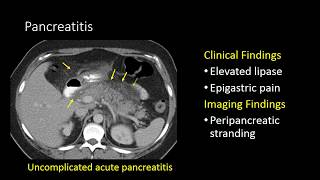 GI Imaging  Pancreatitis [upl. by Eiramacissej]