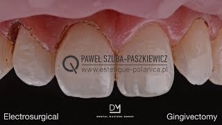 Electrosurgical Gingivectomy  Crown Lengthening [upl. by Anillek208]