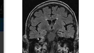 MRI in Epilepsy [upl. by Shult]