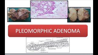 Pleomorphic Adenoma [upl. by Inilam]