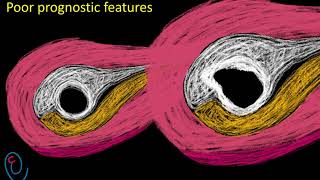 Early pregnancy ultrasound explained  GS  YS and FP [upl. by Cele931]