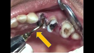 Piezo assisted grossly decayed maxillary teeth removal [upl. by Adekam]