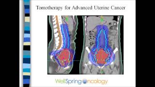 Radiation and Endometrial Cancer [upl. by Enelrihs]