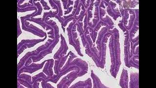 HEMANGIOMA capillary amp Cavernous Clinical features amp Morphology [upl. by Uy]