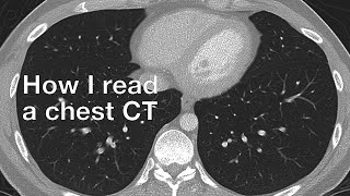 How I Read a Chest CT [upl. by Kutzer]