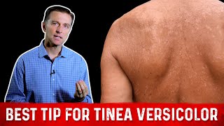 Natural Skin Fungus Tinea Versicolor Home Remedies – Dr Berg [upl. by Necaj484]