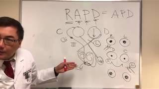 RAPD Relative Afferent Pupillary Defect MarcusGunn pupil [upl. by Shawnee]