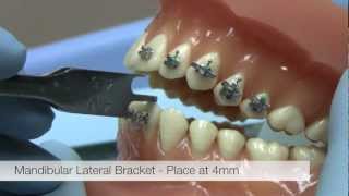 American Orthodontics Alexander LTS Brackets  Bracket Placement Video [upl. by Kcirddec736]