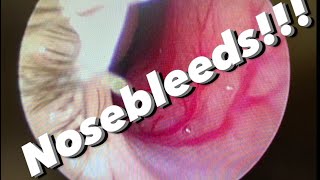 Nosebleeds epistaxis causes prevention treatments and more [upl. by Ainej]