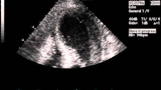 Transthoracic Echocardiogram Showing Akinesis on Apical FourChamber View [upl. by Atiuqan]