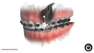 Impacted Canine Aurora Orthodontics [upl. by Chastain]