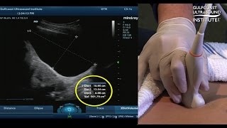 Hot Tip  Measuring Bladder Volume with Ultrasound [upl. by Eibbed167]