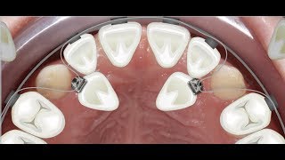 Orthodontic case report for palatally impacted canines traction [upl. by Boru332]