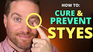 How To CURE And PREVENT STYES Get Rid Of A Hordeolum stye And Chalazion Fast [upl. by Estes]