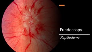 Papilledema Fundoscopy [upl. by Suiravaj]