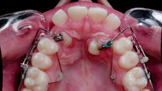 orthodontic treatment for palatally impacted canine WAIT 🔥 [upl. by Htederem]