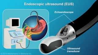 Understanding EUSFNA [upl. by Aidua]