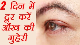 आंख की गुहेरी दूर करने के घरेलु उपाय  How to get rid of a Stye  Eye Care  Hordeolum  Boldsky [upl. by Pier785]