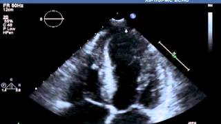 Transthoracic Echocardiographic Images Obtained after Cardiac Catheterization [upl. by Ihana]