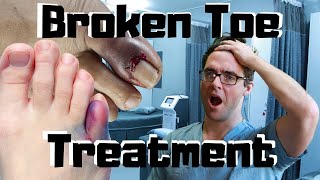 What To Do For A Broken Pinky Toe How To Tape amp Little Toe Treatment [upl. by Ahsiekar]