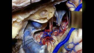 Navigating the Temporal Bone  Part 3 of 3 [upl. by Publius922]