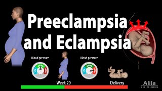 Advanced Obs amp Gyne Lecture THE MANAGEMENT OF SEVERE PRE ECLAMPSIA amp ECLAMPSIA Part 1 [upl. by Ariaj]