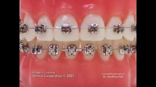 Advanced Orthodontics  Self Ligating Brackets [upl. by Sindee]