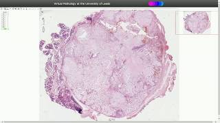 Pleomorphic Adenoma  Histopathology [upl. by Siednarb]