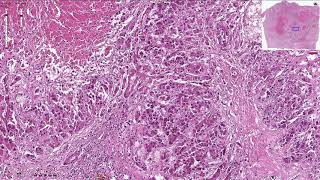 Hepatocellular Carcinoma  Histopathology [upl. by Aicile]