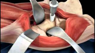 Minimally Invasive Total Hip Replacement  THR  Nucleus Health [upl. by Linet]