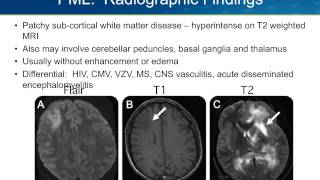 Progressive Multifocal Leukoencephalopathy PML [upl. by Sinclair864]