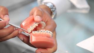 Braces Broken Bracket Poking Wire Braces Pain  Aura Orthodontics [upl. by Rebak]