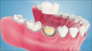 Dental Crown Procedure [upl. by Faustena]