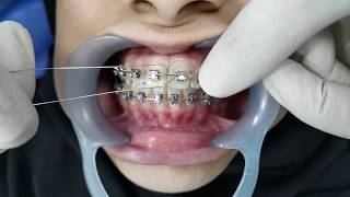 Orthodontic Ligation [upl. by Attenauqa478]