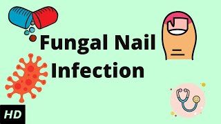 HOW TO TREAT FUNGAL NAIL INFECTION  TINEA UNGUIUM  ONYCHOMYCOSIS [upl. by Gyimah]