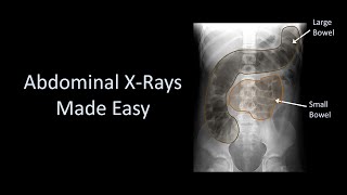 Abdominal XRays Made Easy [upl. by Queen628]