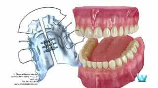 Ortodoncia Estética o Prevención para la salud bucal [upl. by Carol-Jean205]