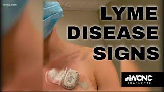 Lyme Disease Is On The Rise And Its Bad [upl. by Enialem510]