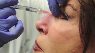 Nonsurgical Rhinoplasty [upl. by Zela]