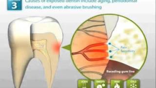 Demineralized Tooth Enamel Dynamics of Treatment [upl. by Adnorahs]