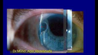 Slit lamp examination  whole presentation [upl. by Nari]