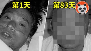 核輻射死亡83天全紀錄，看著自己融化是種什麼體驗？他遭受2萬倍的輻射量，世界上死的最慘的人【🐼熊貓周周】 [upl. by Adnih]