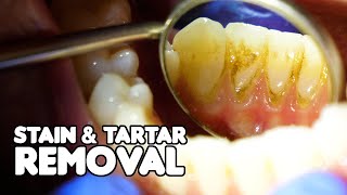 Dental Cleaning EXPLAINED  Stain amp Tartar Removal [upl. by Ecerahc622]