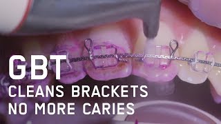 Brackets with GBT  Guided Biofilm Therapy [upl. by Hopkins]